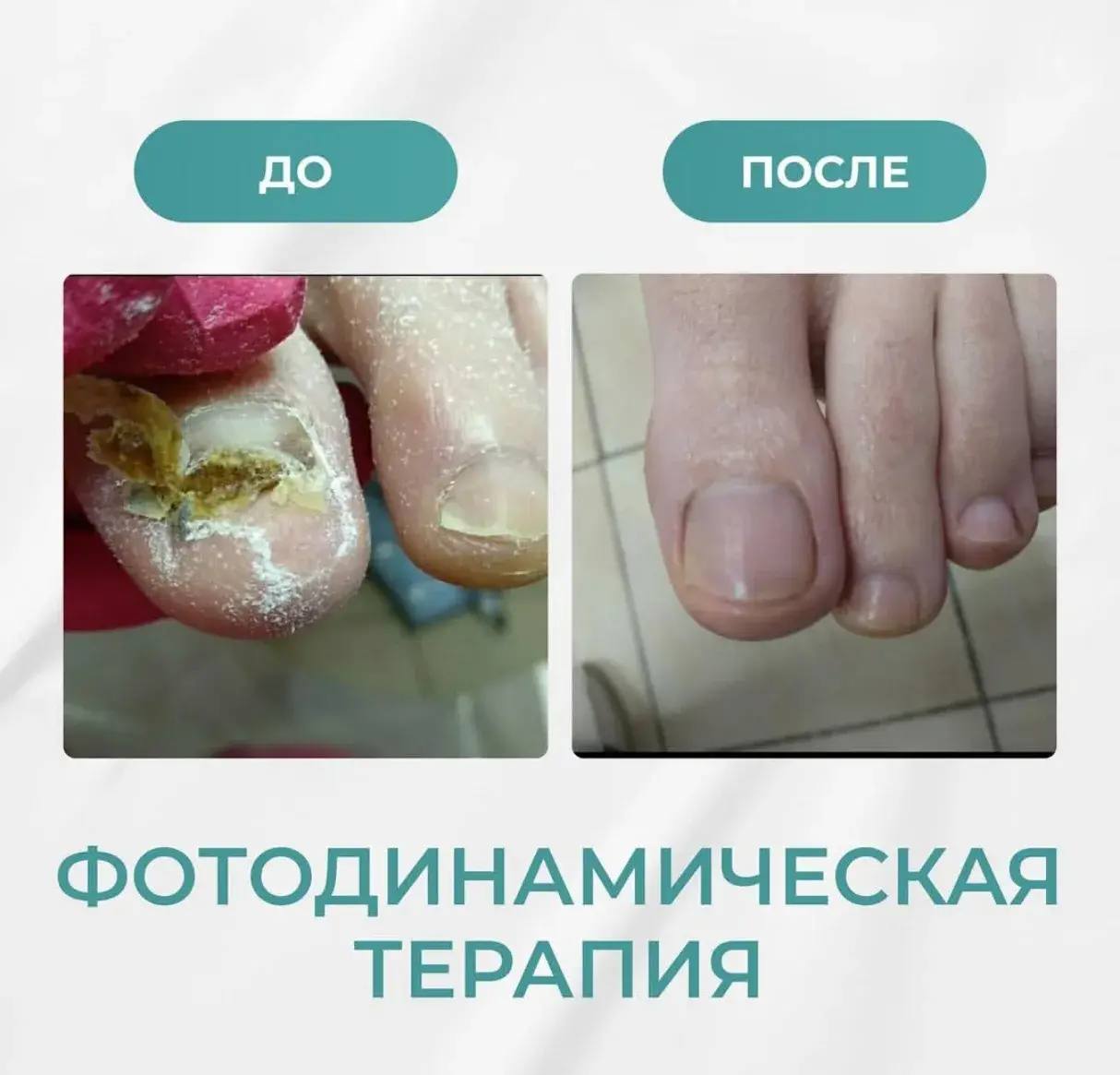 Состояние ногтя до и после курса фотодинамической терапии