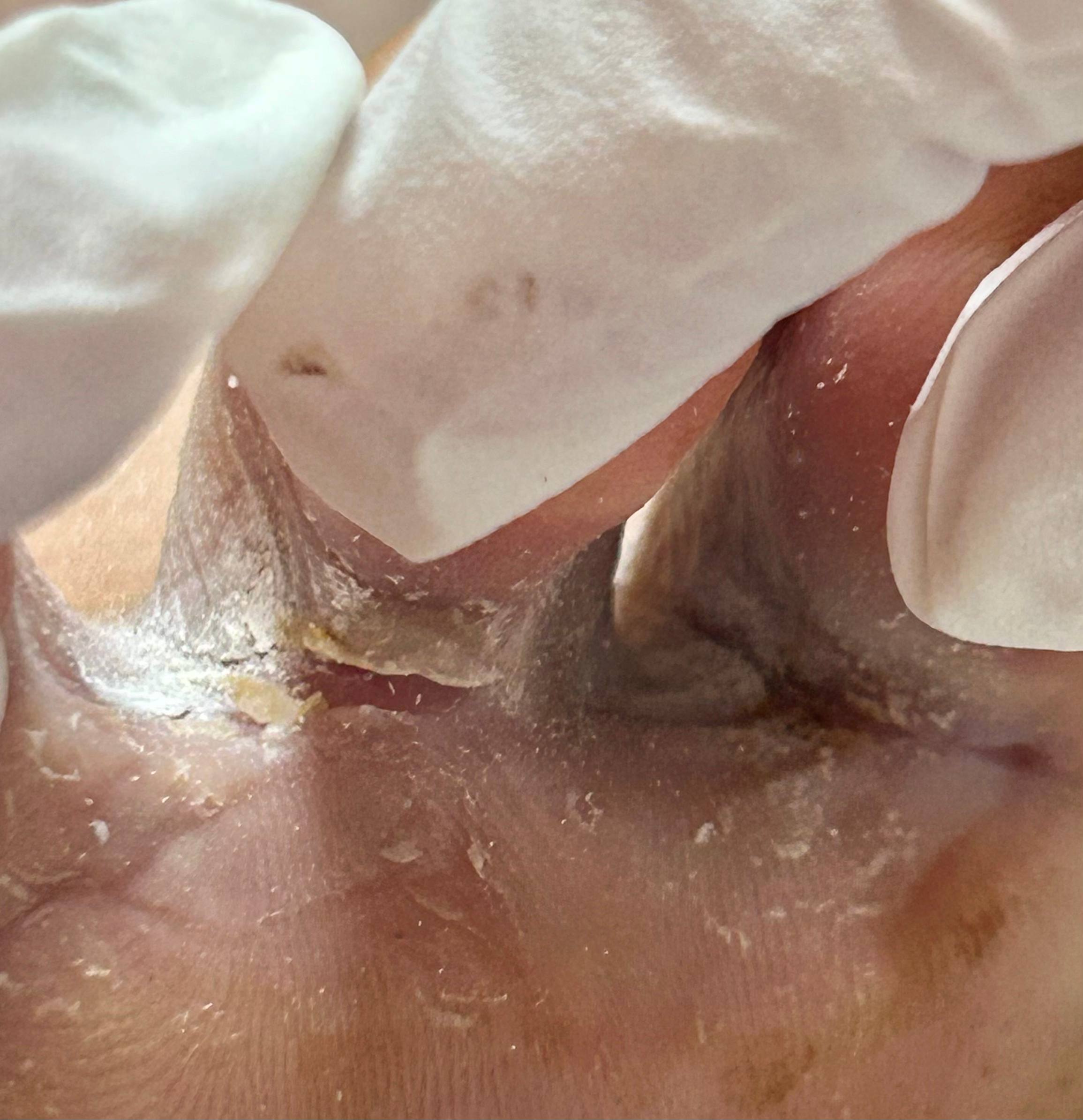 Пример микоза стопы