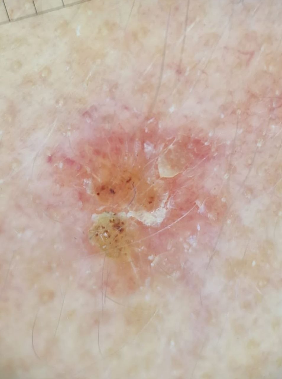 Новообразование кожи до оценки на дерматоскопе РДС-3