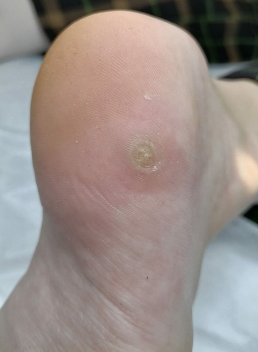 До лечения Бородавки