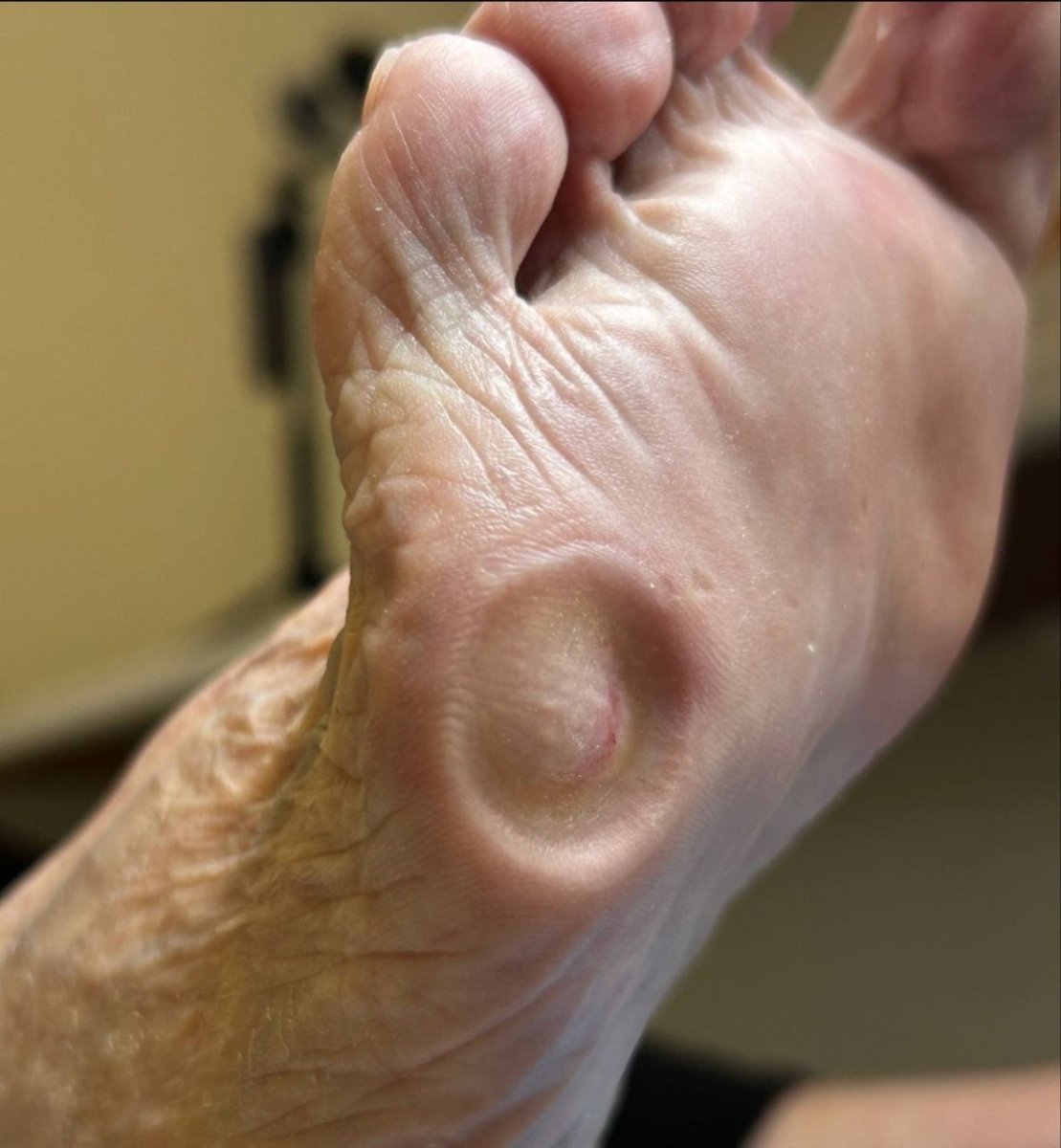 После лечения Мозоли