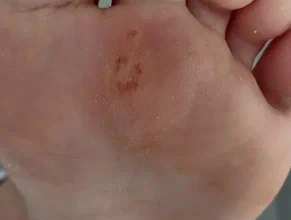 После лечения